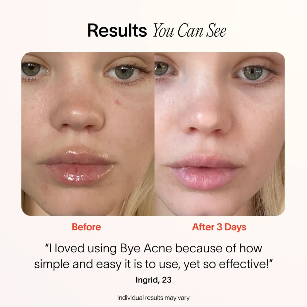 Bye Acne™ 3-Minuten Behandeling